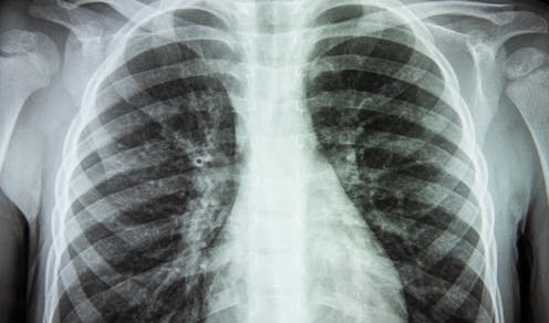 No PCR, no problem: how COVID can be diagnosed with X-rays
