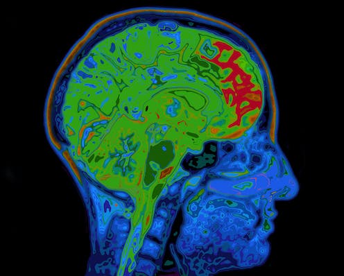 People with obsessive-compulsive disorder have an imbalance of brain chemicals – our discovery could mean a treatment breakthrough