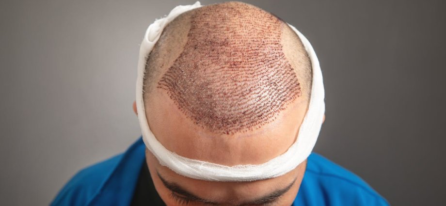 As hair transplants become big business, here’s what you need to know about the risks