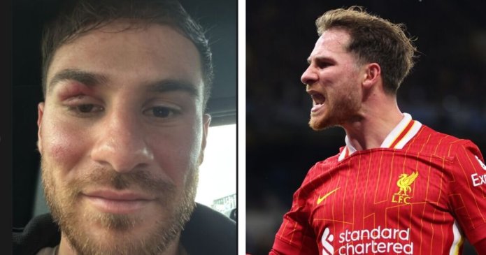 Liverpool's Alexis Mac Allister shows off gruesome black eye after Man City win