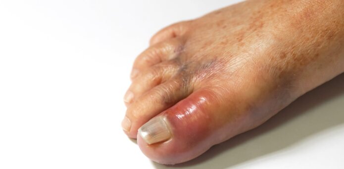 Gout used to be an affliction of royalty but is now a disease of the masses