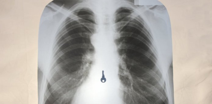 From Tiffany earrings to mobile phones – this is what happens when you swallow something you shouldn’t