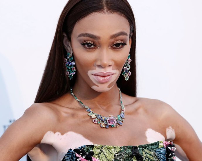 Vitiligo affects around 1 in 100 people worldwide – yet the skin condition remains misunderstood