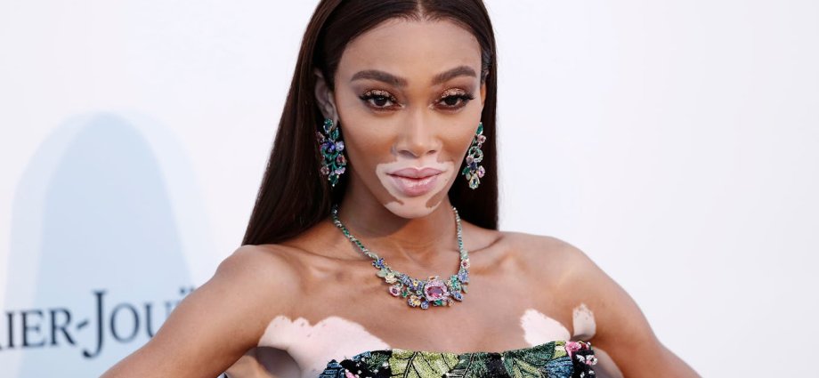 Vitiligo affects around 1 in 100 people worldwide – yet the skin condition remains misunderstood