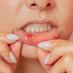 Mouth ulcers: why have I got them and how can I get rid of them?