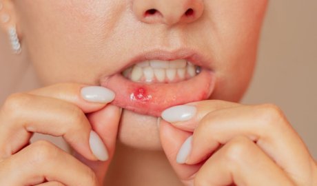 Mouth ulcers: why have I got them and how can I get rid of them?