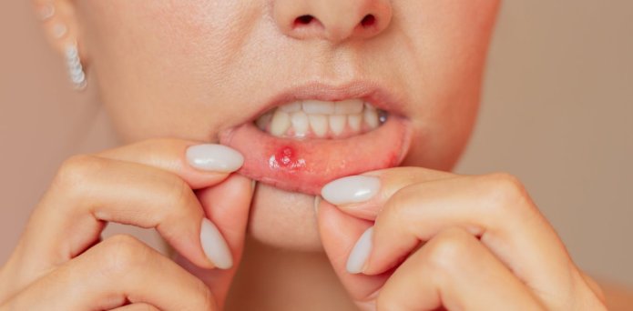 Mouth ulcers: why have I got them and how can I get rid of them?