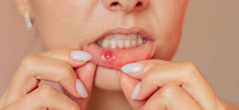 Mouth ulcers: why have I got them and how can I get rid of them?