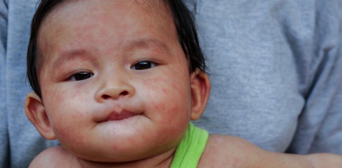 Vaccines have been so successful that some people have forgotten why we need them